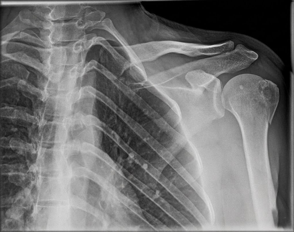 X-ray of a human shoulder joint, illustrating orthopaedic and post-surgical rehabilitation care